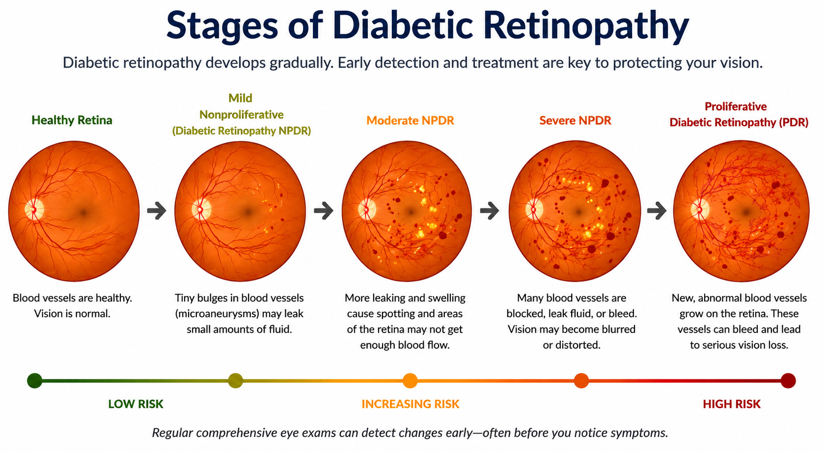 Stages of Diabetic Retinopathy Stages of Diabetic Retinopathy
